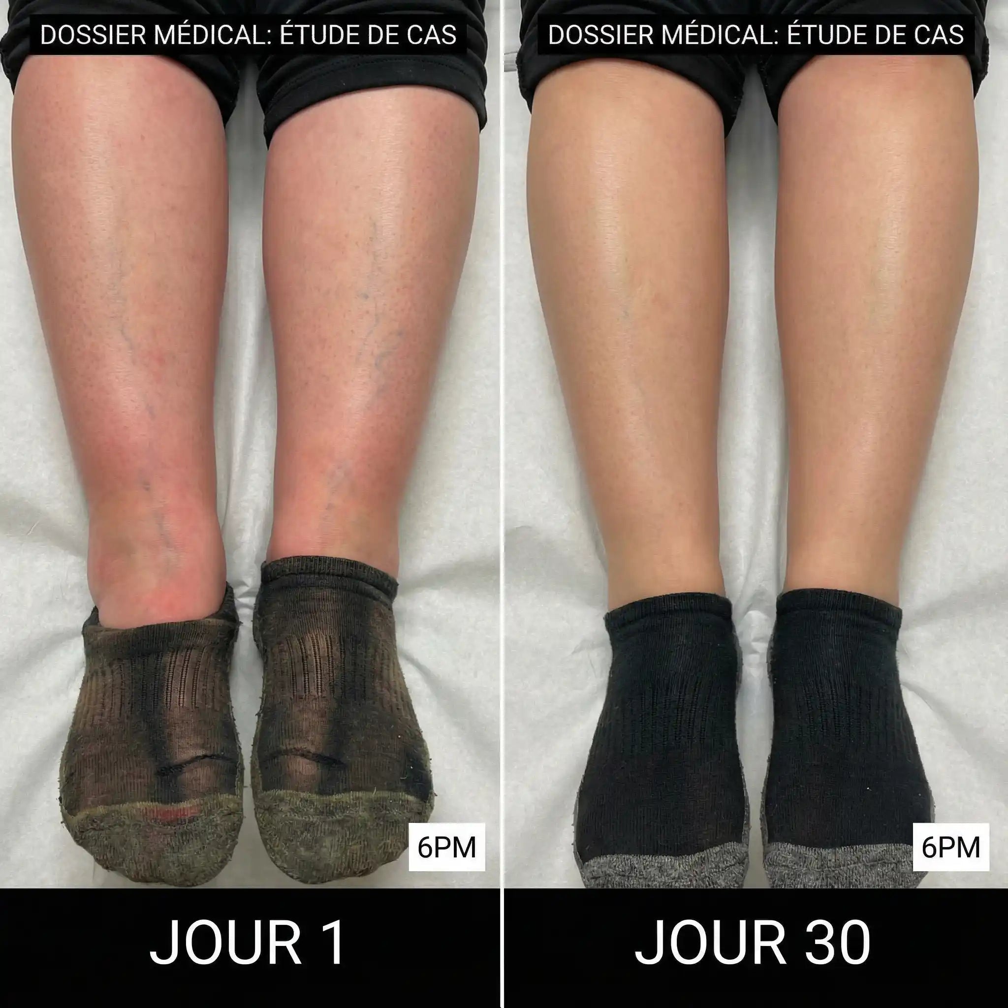 Avant/Après - Résultats après 30 jours