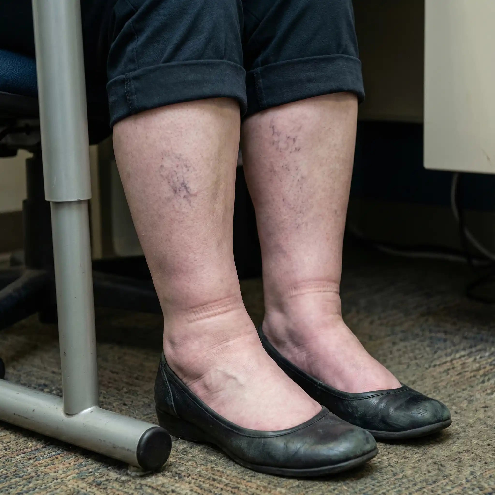 Chevilles gonflées et jambes lourdes en fin de journée